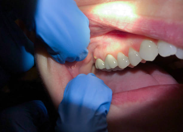 Emergency Dental Filling Replacement in OH