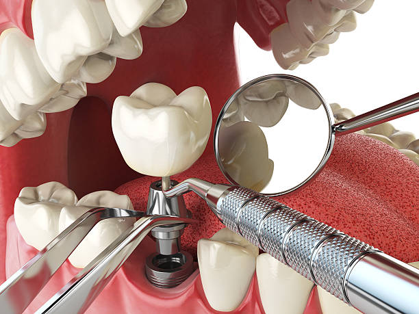 Best Root Canal Emergency Dentist  in Brimfield, OH